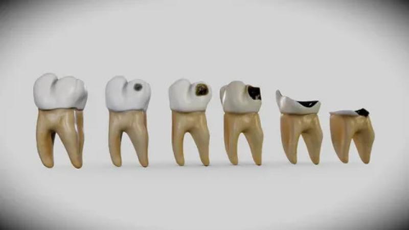 Dental Caries Treatment