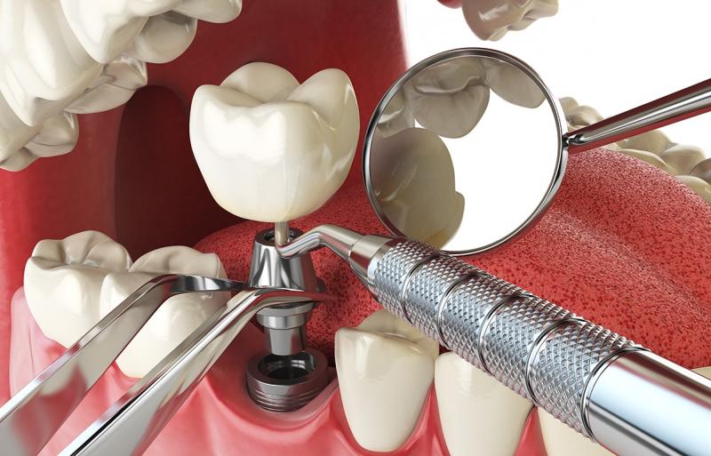  Dental Implants