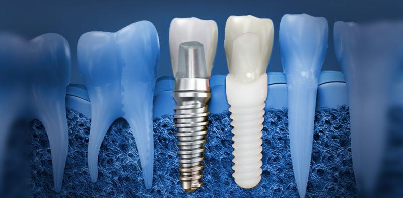 Dental Implants Market