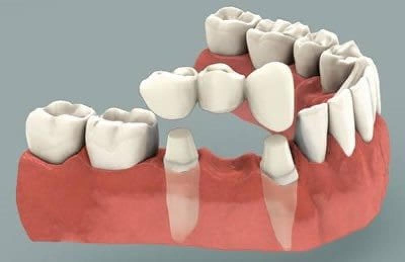 Dental Crown And Bridges Market
