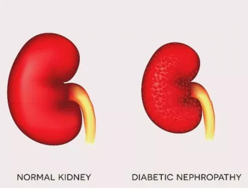 Diabetic Nephropathy Market
