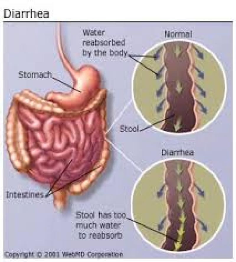 Diarrhea Pipeline, Drugs and Companies Review 2015