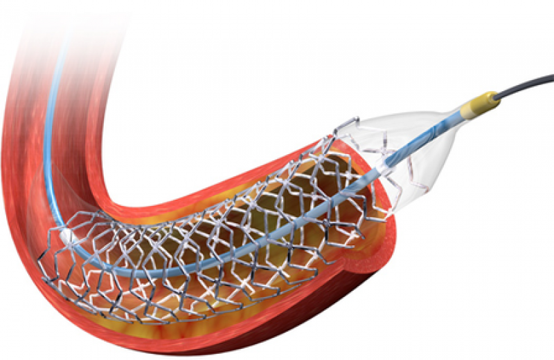 Виды стентов. Стенты Biomatrix. Des Biomatrix Flex стент. Стент Biomatrix Alpha. Стент SUPRAFLEX