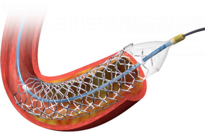 Система стента. Стенты Biomatrix. Des Biomatrix Flex стент. Стент Biomatrix Alpha. Стент SUPRAFLEX.