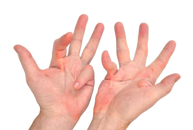 Dupuytrens Disease