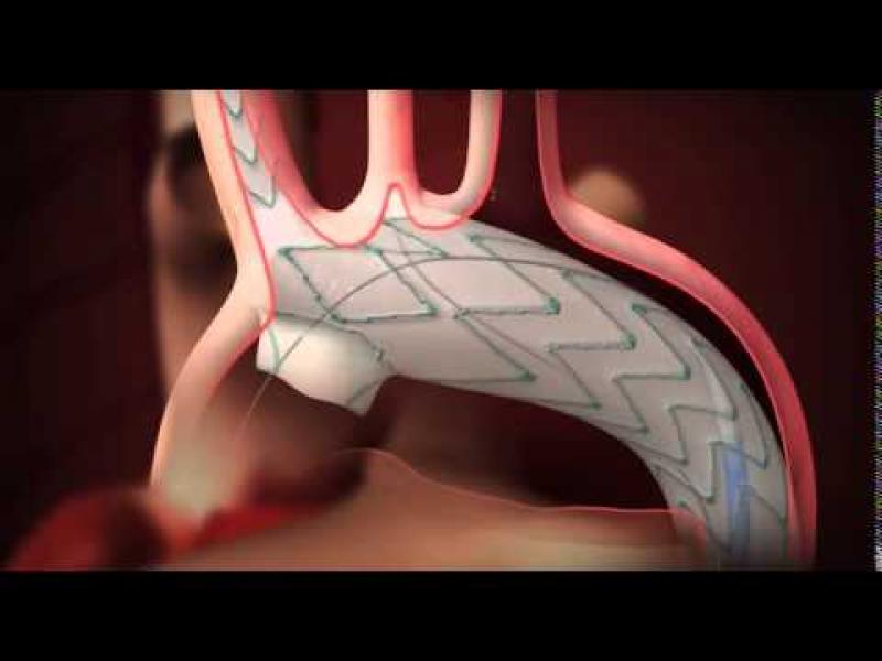 Endovascular Stent Graft