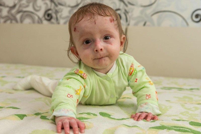 Five-Year-Old Launches Campaign For People With Butterfly Skin Disease