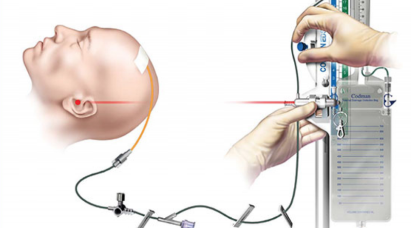 External Ventricular Drain Market