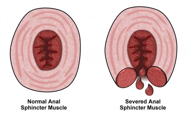 Fecal Incontinence Market