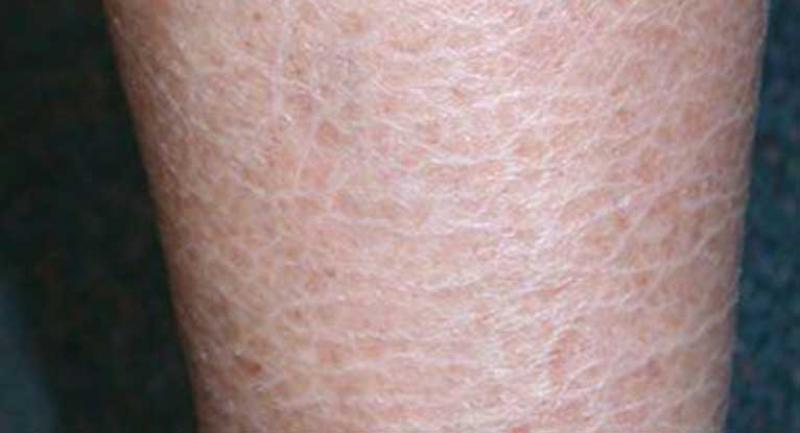 Fish Skin Disease Market