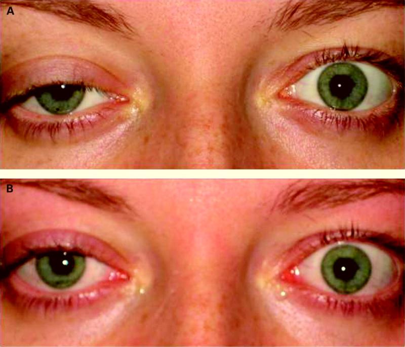 Global Allan-Herndon-Dudley Syndrome Treatment 