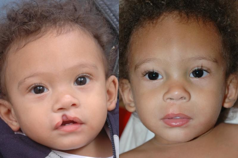 Cleft Lip Surgery Market