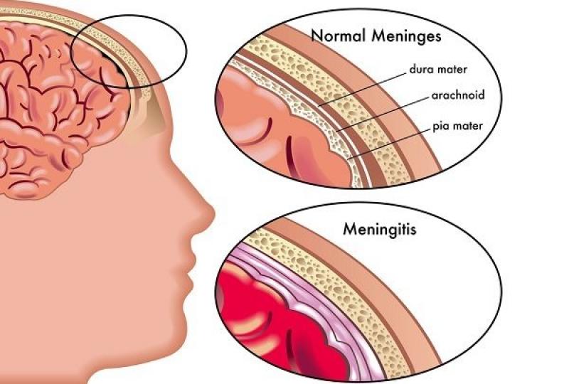 Global Meningitis Diagnosis and Treatment Market