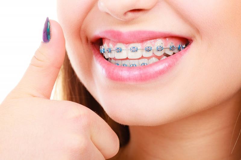 Global Orthodontic Brackets Market