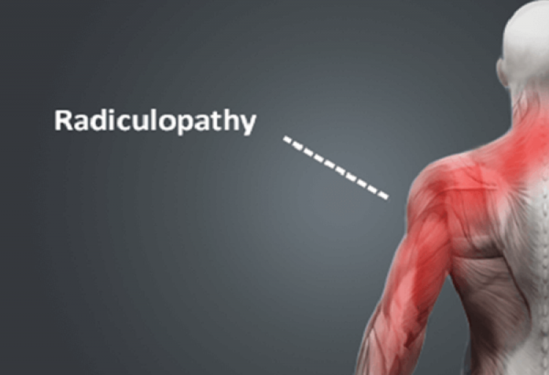 Global Radiculopathy Market