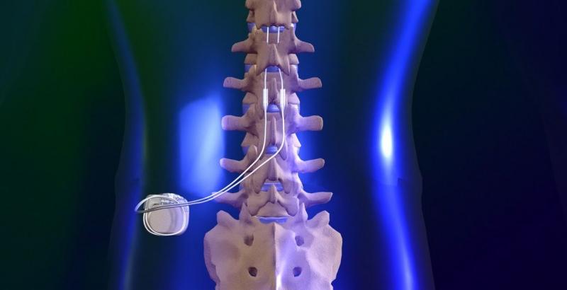 Global Spinal Laminoplasty Market