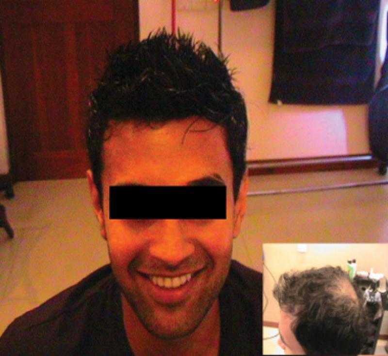 Hair loss treatment in Kandivali