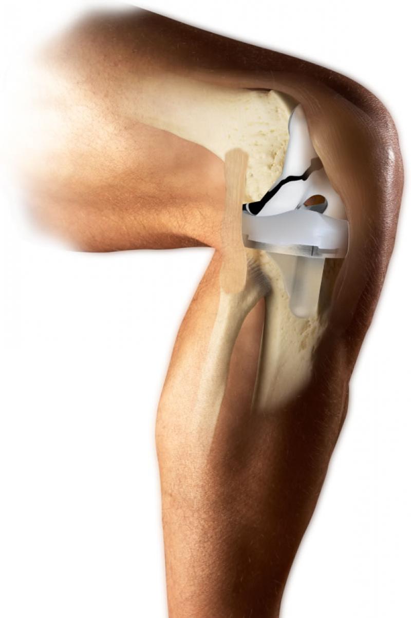 Эндопротезирование коленного сустава клиника. Эндопротез коленного сустава. Эндопротез Triathlon. Титановый эндопротез коленный.