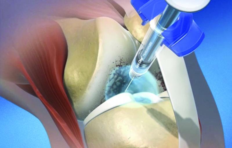 Hyaluronic Acid Viscosupplementation Market