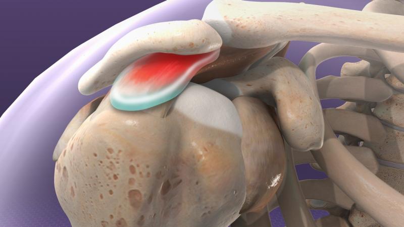 Impingement Syndrome Market