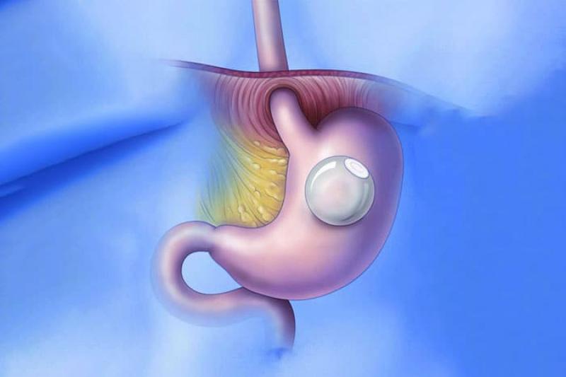 Intragastric Balloon Market 