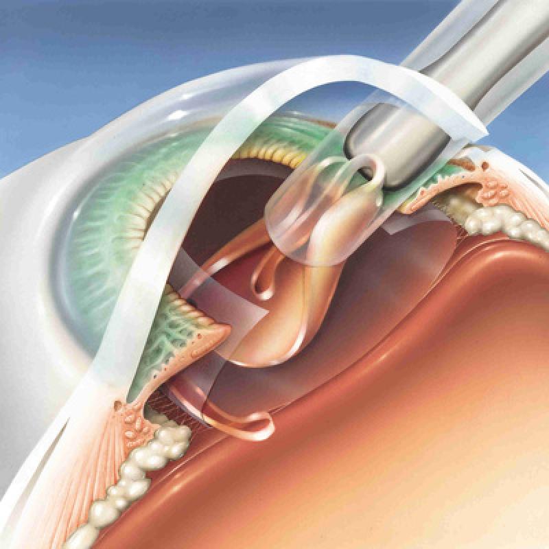 Intraocular Lens Market
