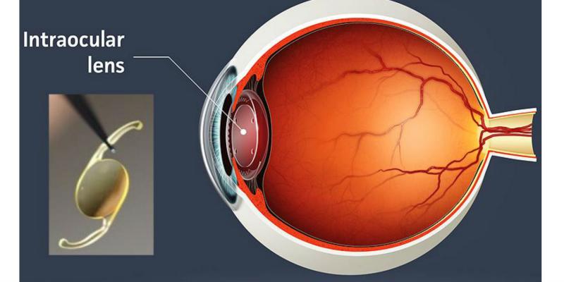  Soft Intraocular Lens Market