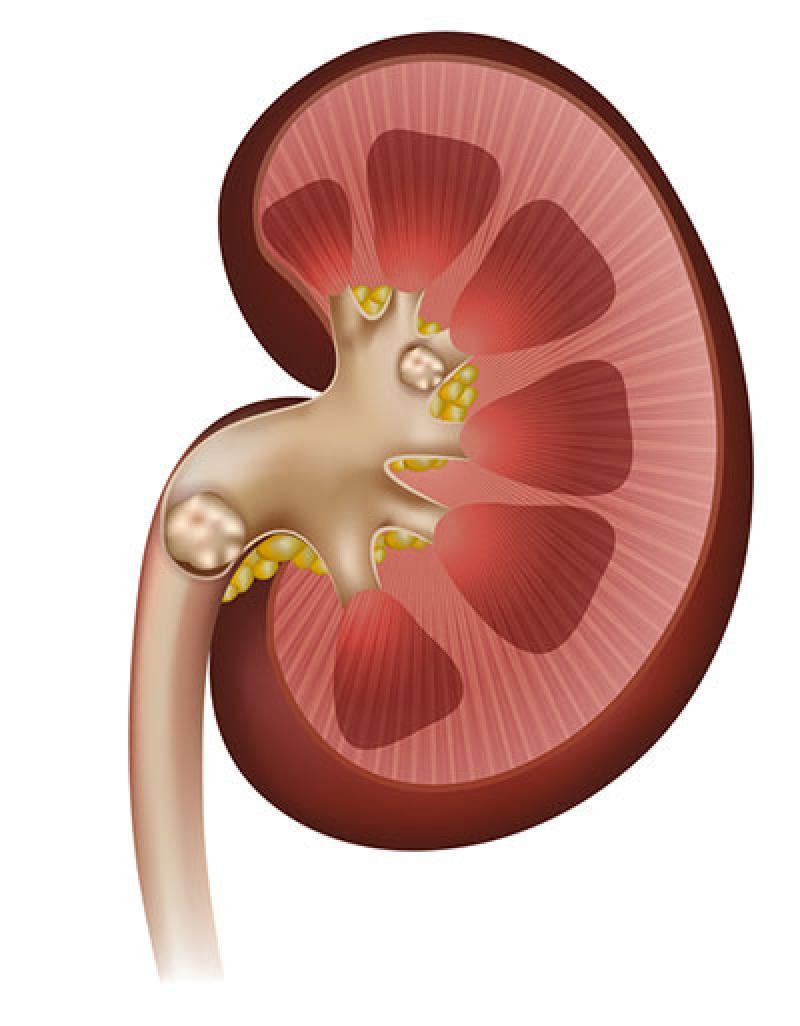 Kidney Stones