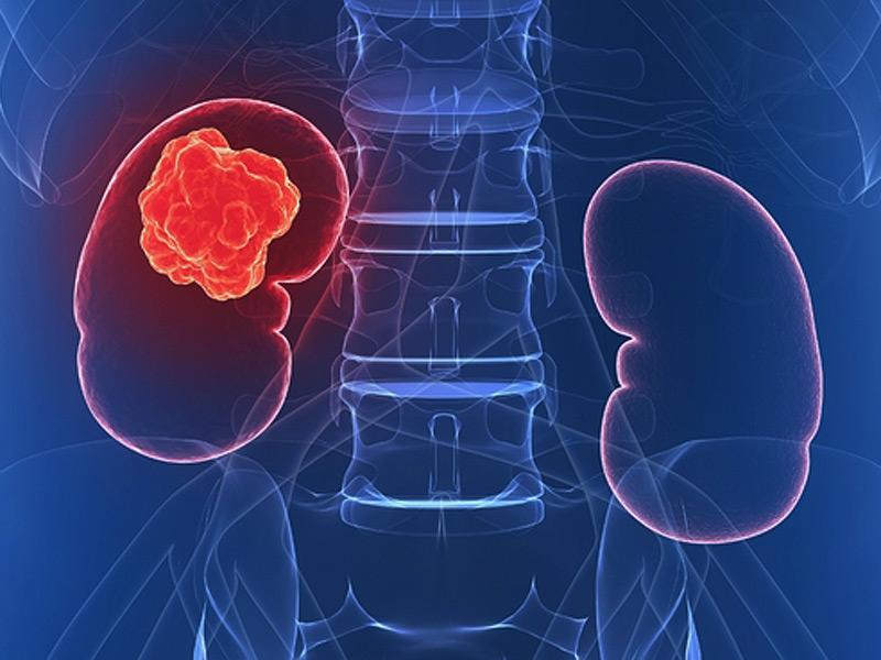 Kidney Cancer Drug Market