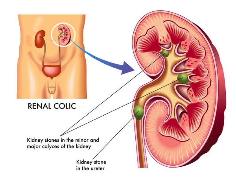 Kidney Stone Doctor In Delhi NCR