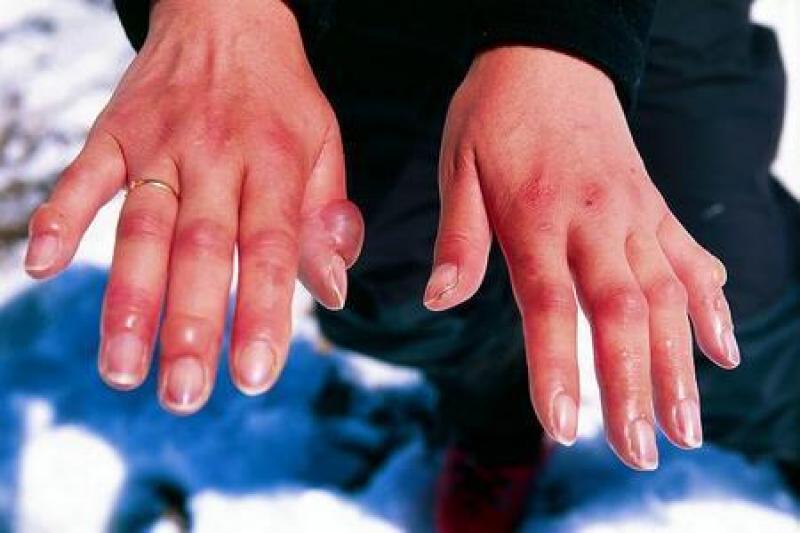 Leprosy treatment Market 