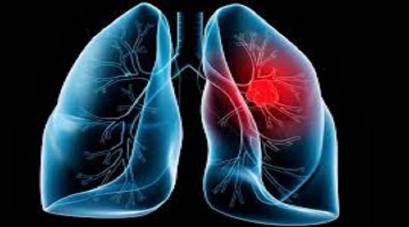 Lung Injury Global Clinical Market Analysis