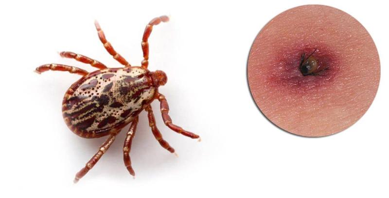Lyme Disease Lyme Disease