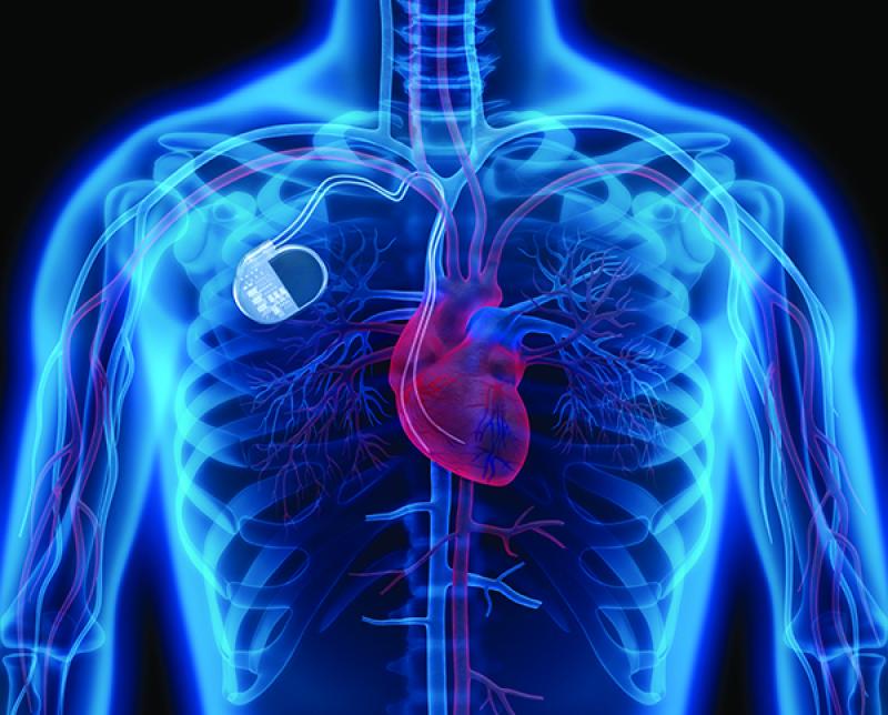 Medical Implant Market