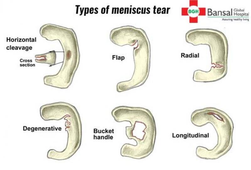 Meniscus Tears