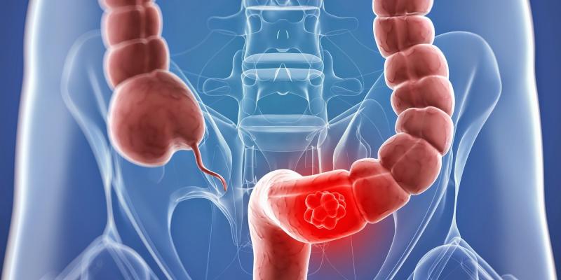 Metastatic Colorectal Cancer 