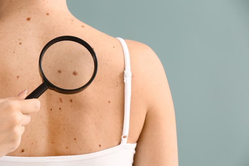  Metastatic Melanoma Therapeutics Market 
