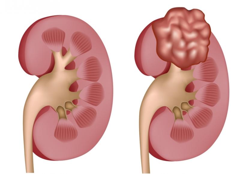 Global Kidney Cancer Diagnostics and Therapeutics