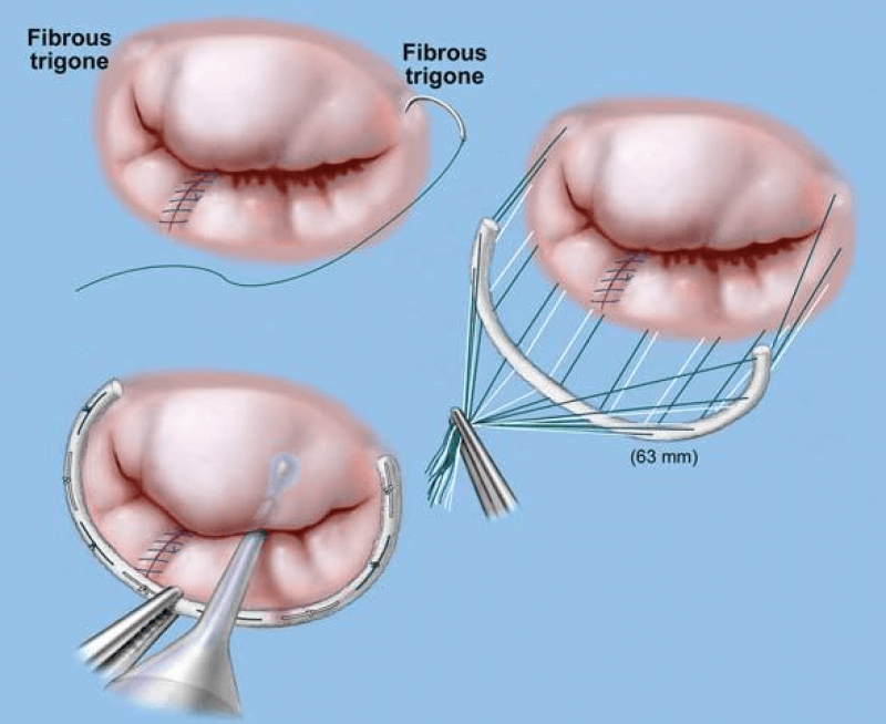 Mitral Valve Annuloplasty Rings Market