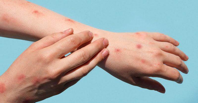 Monkeypox Treatment Market