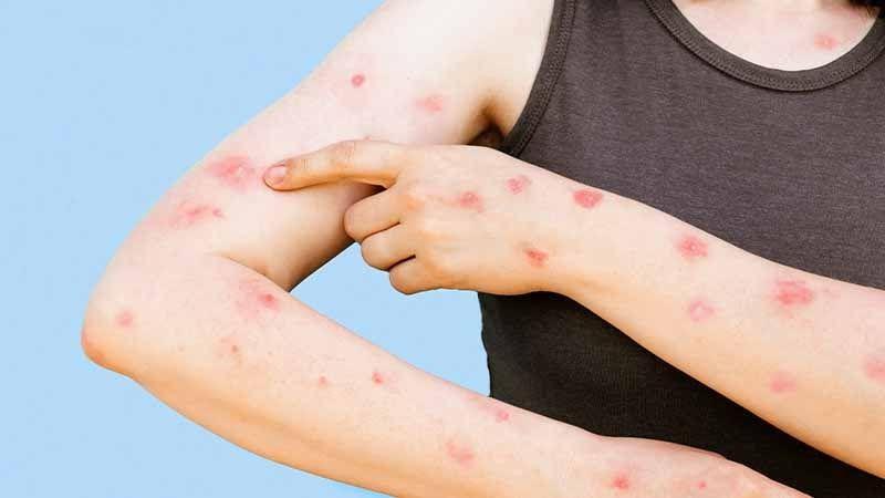 Monkeypox Treatment