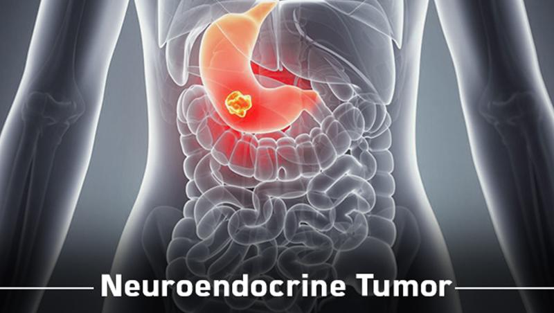 Neuroendocrine Tumor Treatment