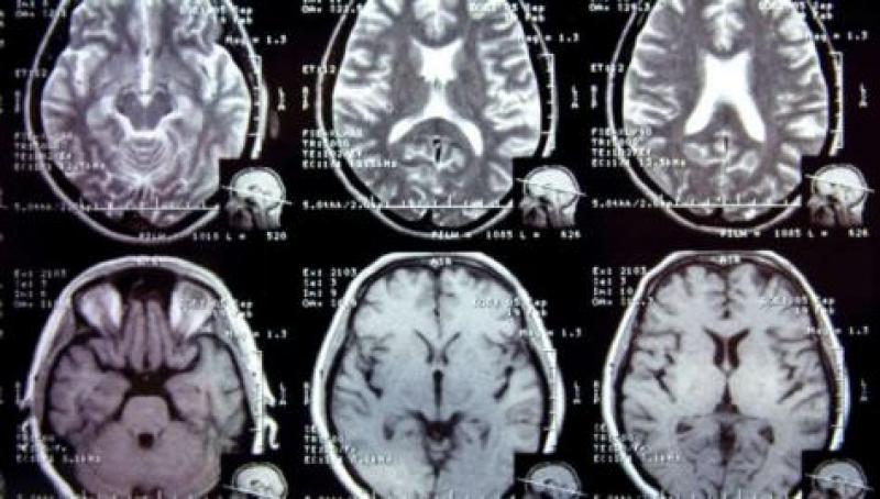 Neurological Disorder Diagnostics Market