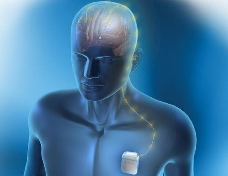Neurostimulation Devices Market