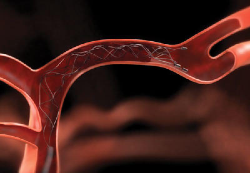 Neurovascular Devices/Interventional Neurology Market