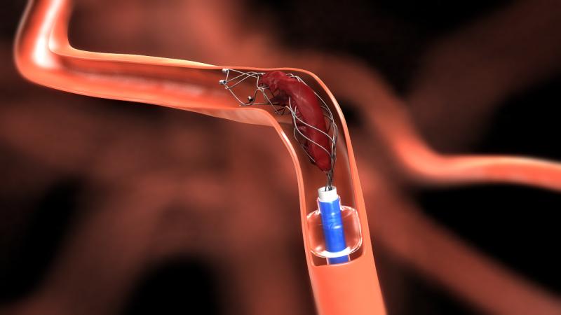 Neurovascular Devices/Interventional Neurology 