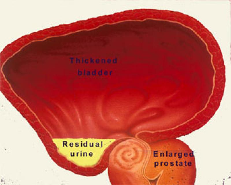 Nocturia Market