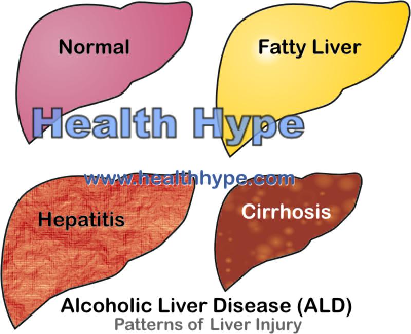 Non Alcoholic Fatty Liver Disease (NAFLD) Global Clinical Trials Review 2015