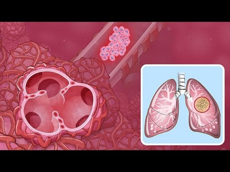 Non-Small Cell Lung Cancer  Market 