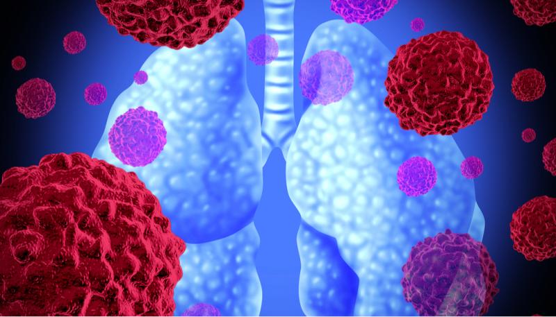 Non-Small Cell Lung Cancer Treatment Market 